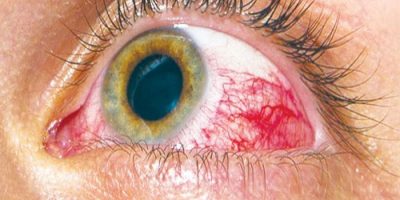 Diyabetik Retinopati (Göz içi kanama, bantla)