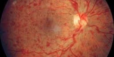 Retina Damar Tıkanıklıkları